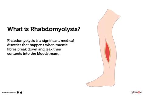 Explainer: what is rhabdomyolysis and what’s its .